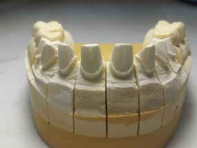 PHỤC HÌNH GIA CÔNG SƯỜN